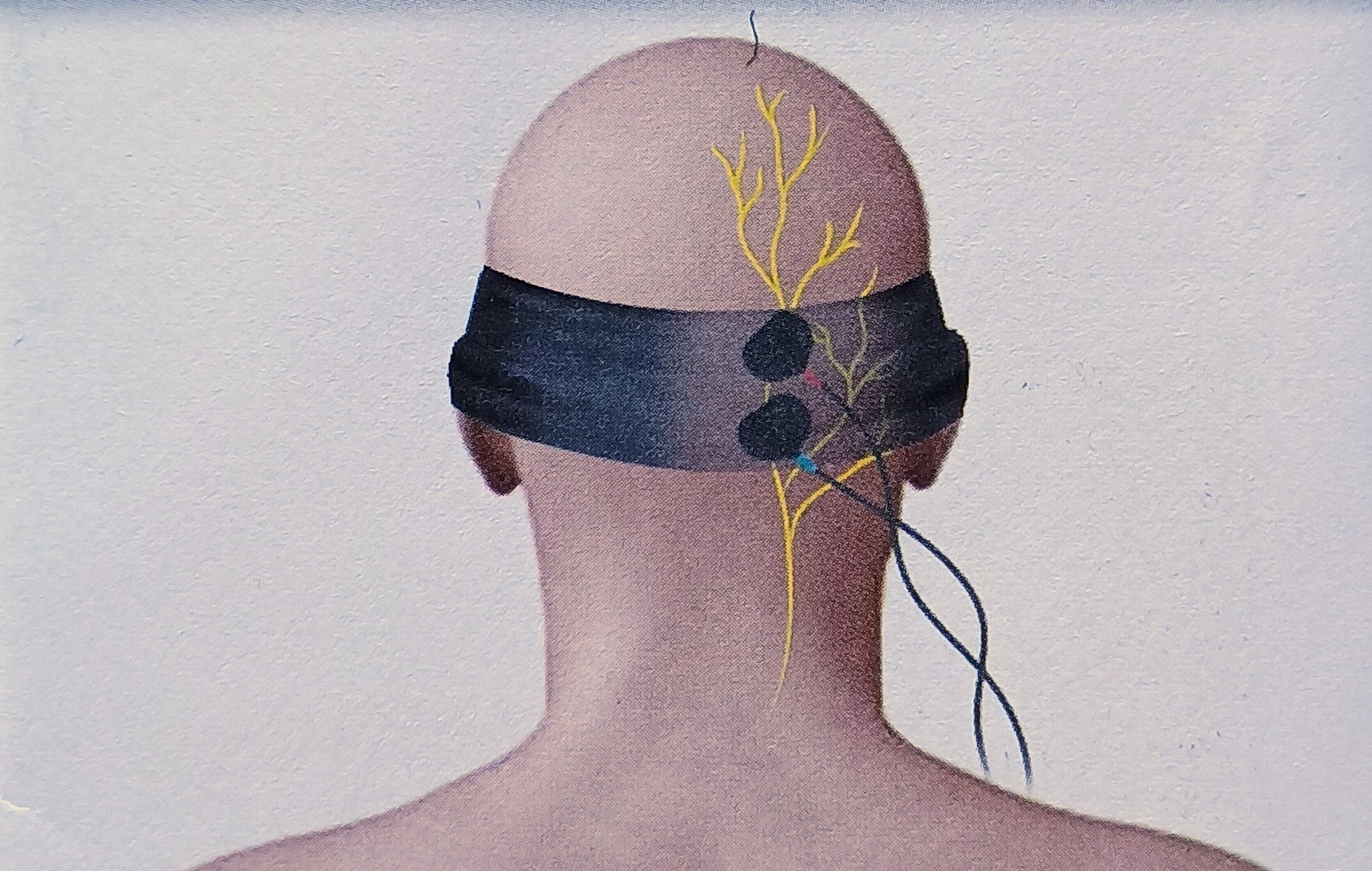 postion des electrodes kit d'arnold